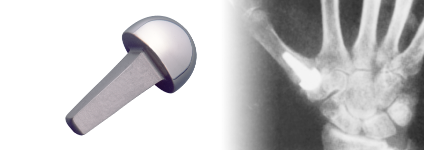 SWANSON Titanium Basal Thumb Implants