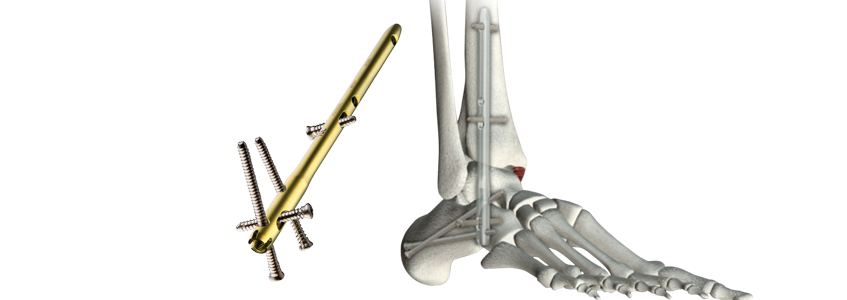 PDF] Total Ankle Replacement Conversion to Tibiotalocalcaneal Arthrodesis  With Bulk Femoral Head Allograft and Pseudoelastic Intramedullary Nail  Providing Sustained Joint Compression | Semantic Scholar